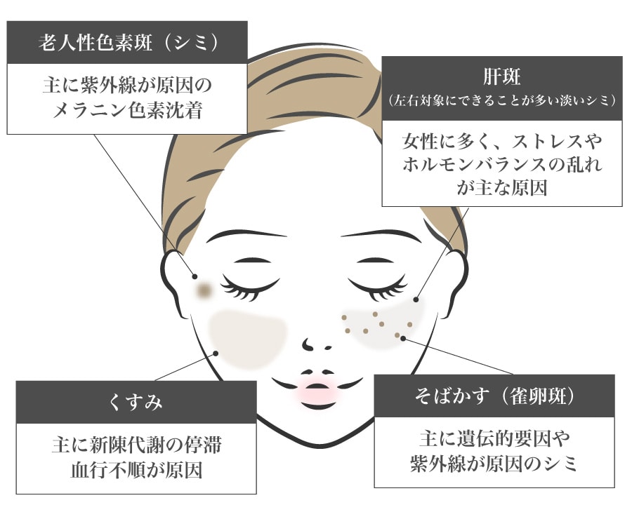 シミの種類