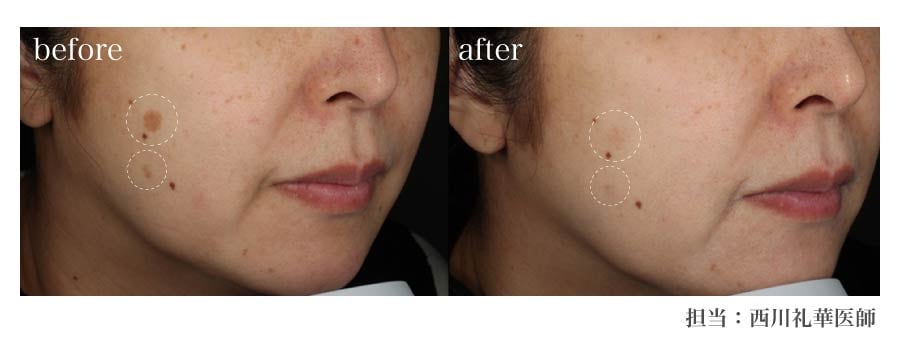 一度の施術で効果抜群