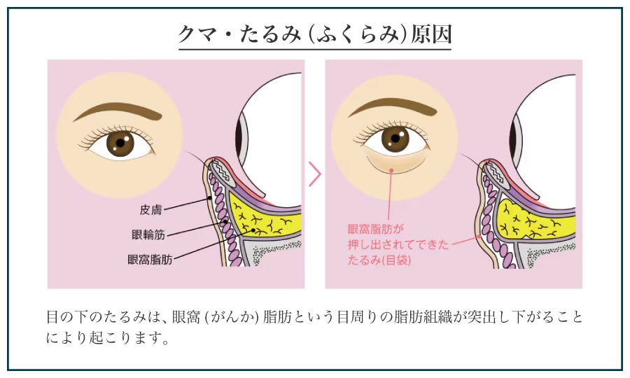 黒クマ・ふくらみの原因