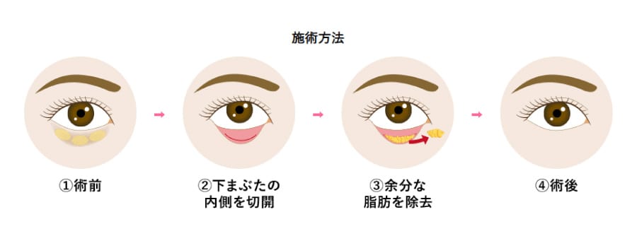 目の下の切らないクマ・たるみ(ふくらみ)取り(脱脂術)とは