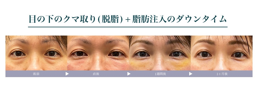 クマ取りのダウンタイム