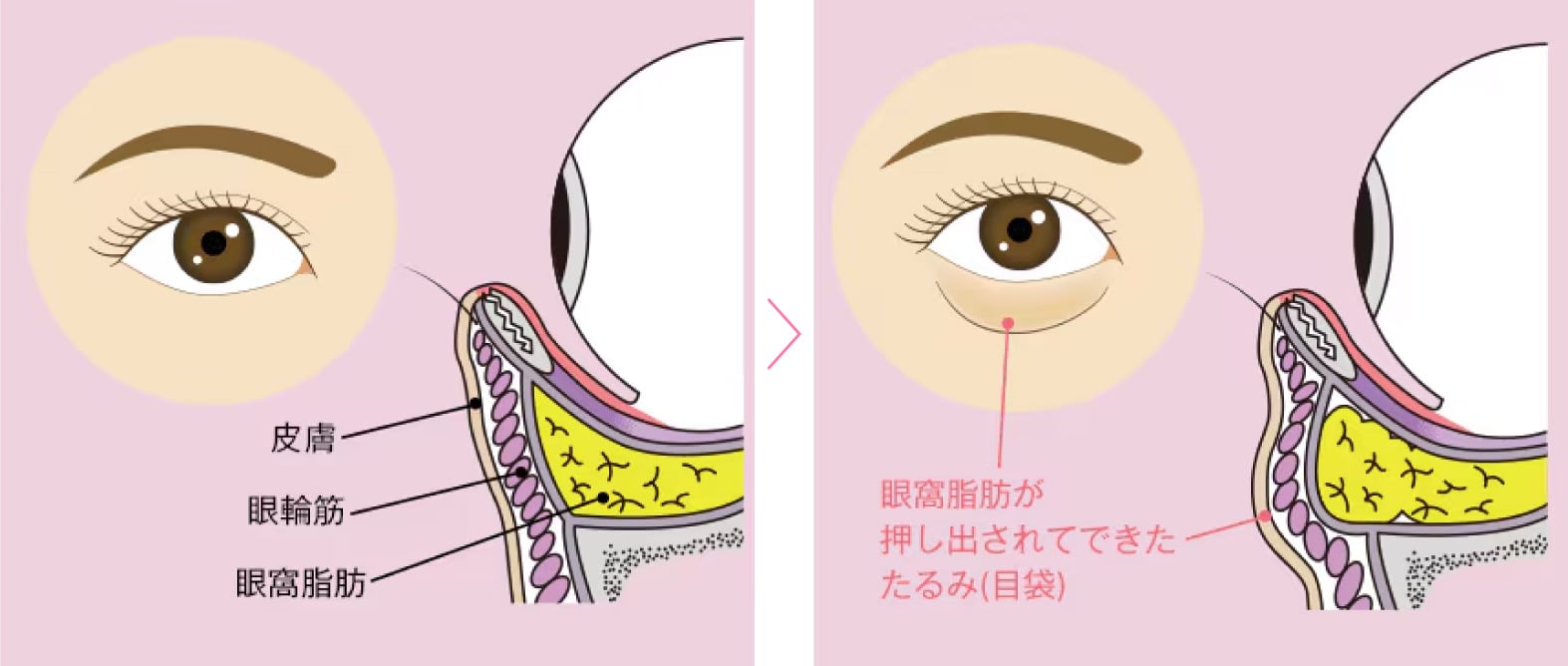 目元の影ってどうしてできるの