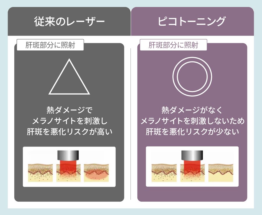 従来のレーザーとピコトーニングの違い