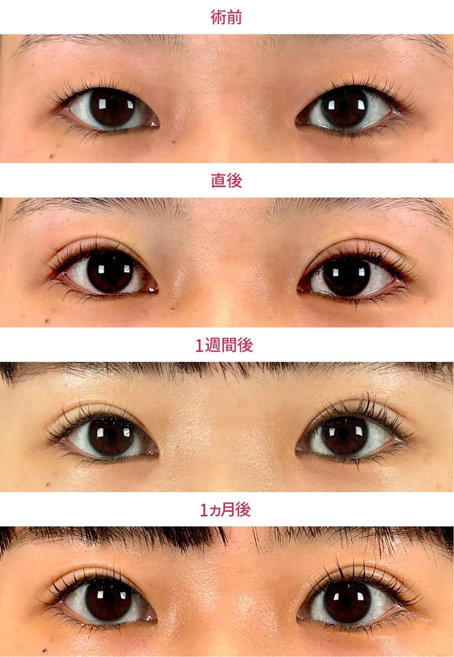 腫れや内出血はどれくらい?