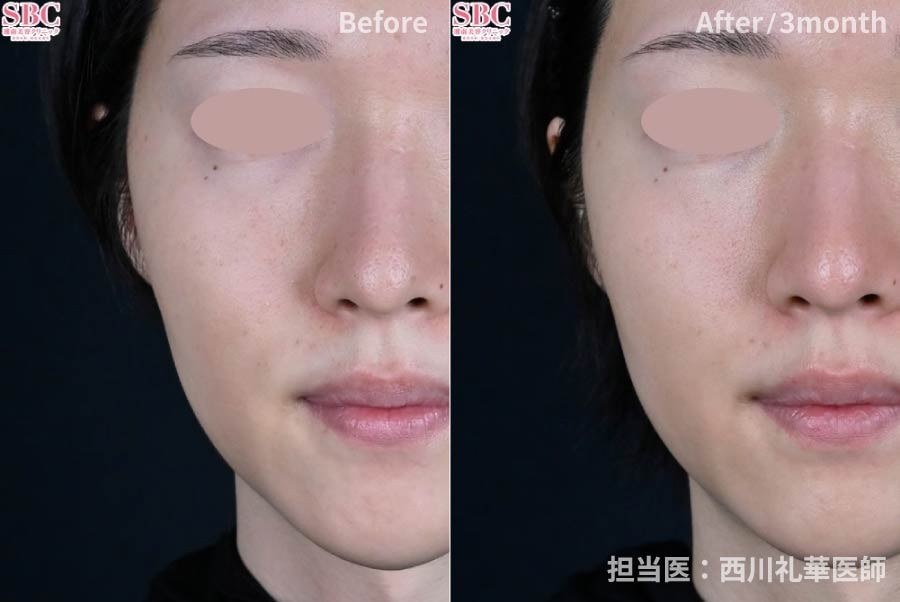 フェイスラインの引き締め+ハリ感UP！