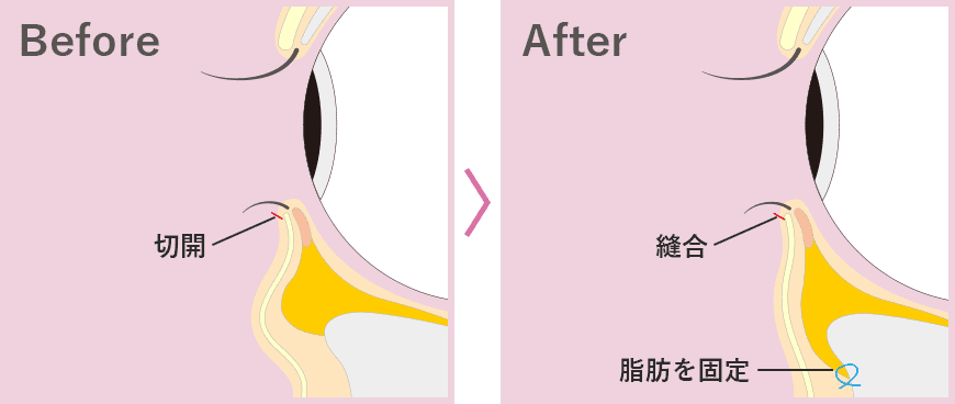 切開ハムラ（表ハムラ法）の場合