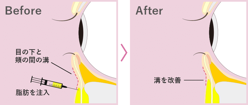 脱脂＋脂肪注入の場合