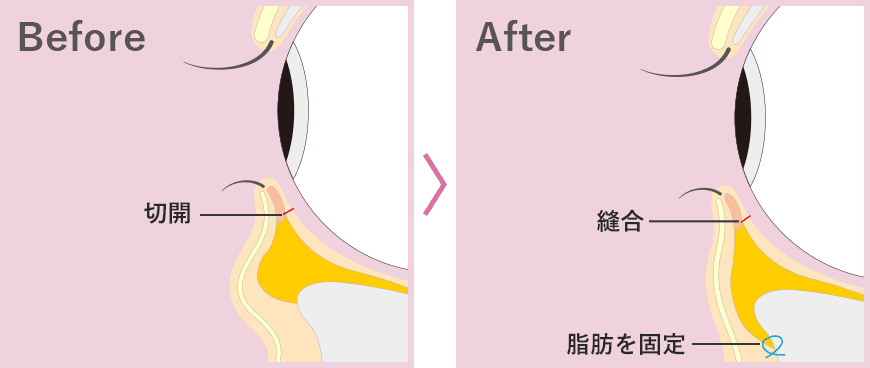 裏ハムラ法の場合