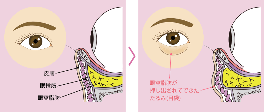 脱脂のみの場合
