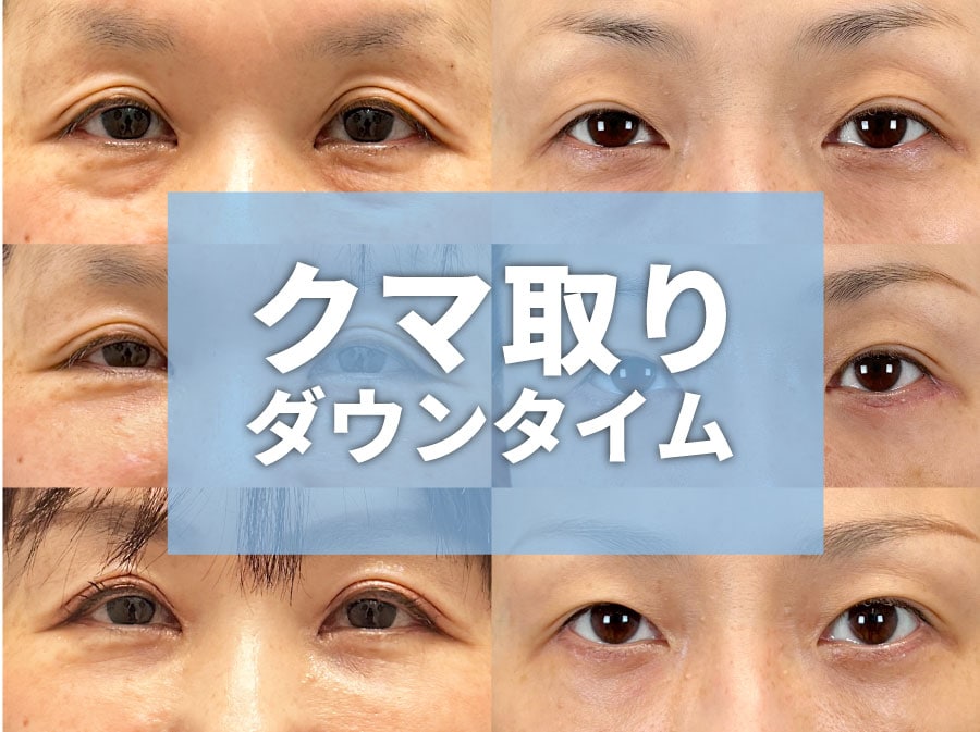 【湘南美容クリニック枚方院】クマ取り治療別にダウンタイムを徹底解説