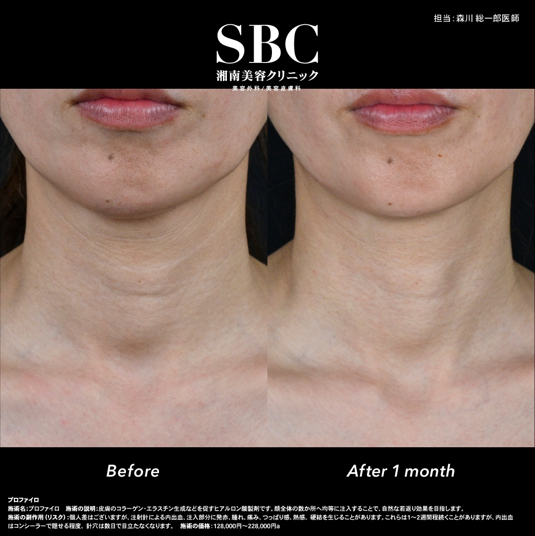 年齢を感じやすい首のシワも改善！