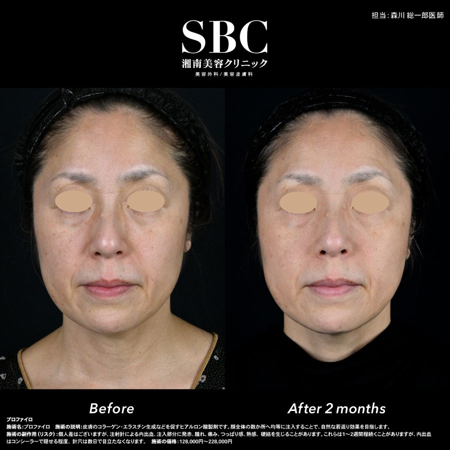 ほうれい線が改善し自然な若返り！