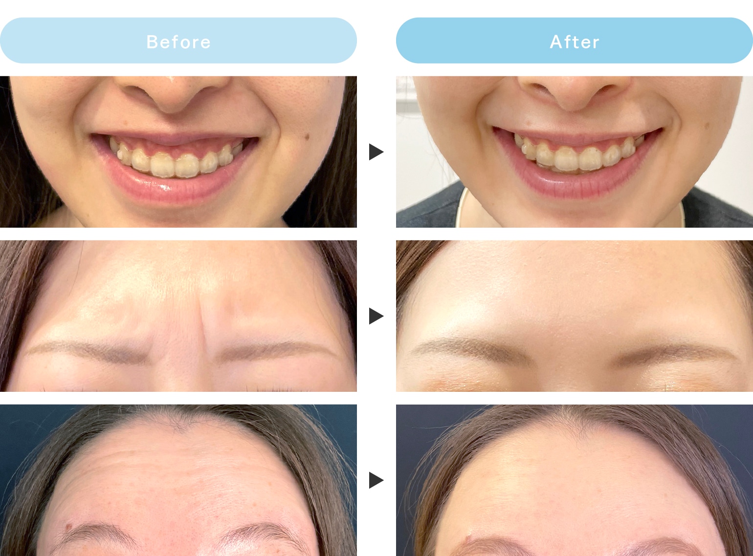 広島 ボトックス】ボトックス施術をお考えの方へ！湘南美容クリニック広島院にお任せください - 広島院, image size:1540x1138