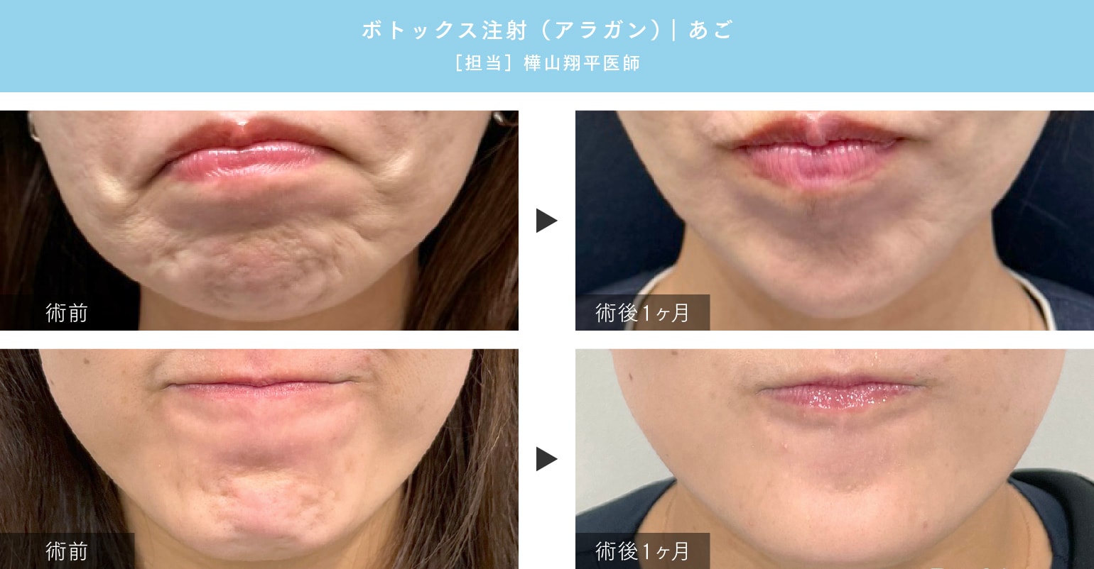 広島 ボトックス】ボトックス施術をお考えの方へ！湘南美容クリニック広島院にお任せください - 広島院, image size:1540x802