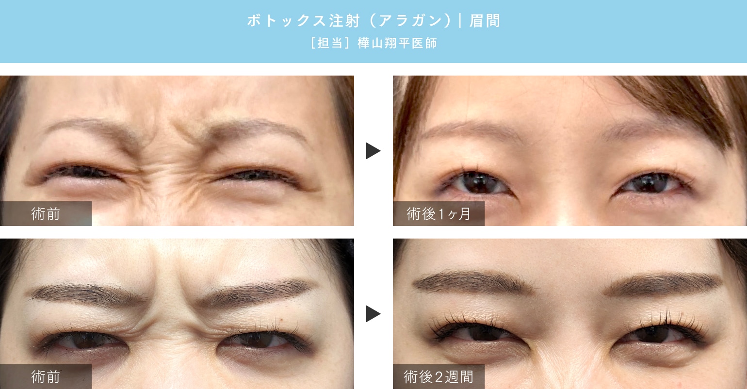 広島 ボトックス】ボトックス施術をお考えの方へ！湘南美容クリニック広島院にお任せください - 広島院, image size:1540x802