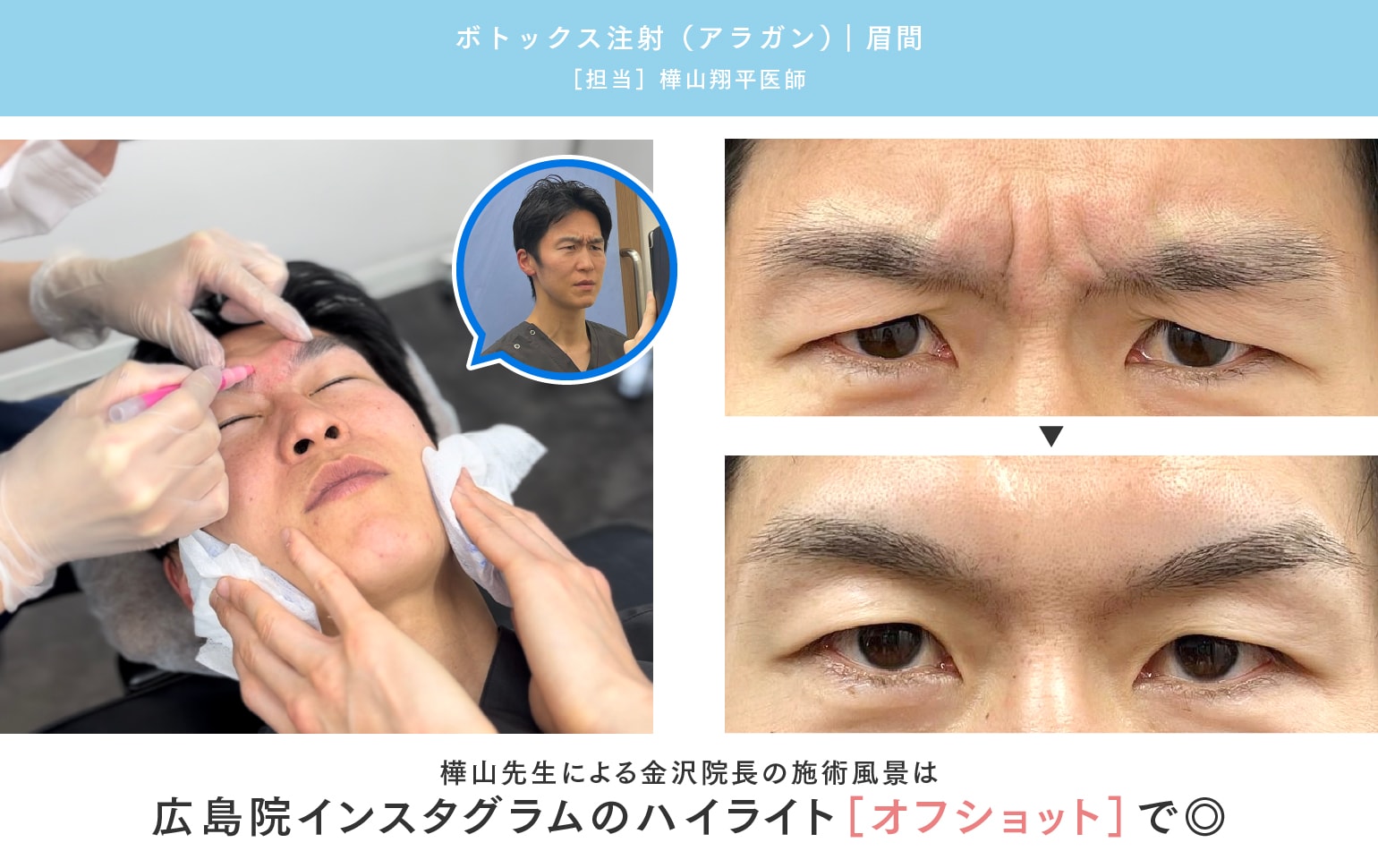 広島 ボトックス】ボトックス施術をお考えの方へ！湘南美容クリニック広島院にお任せください - 広島院, image size:1540x970