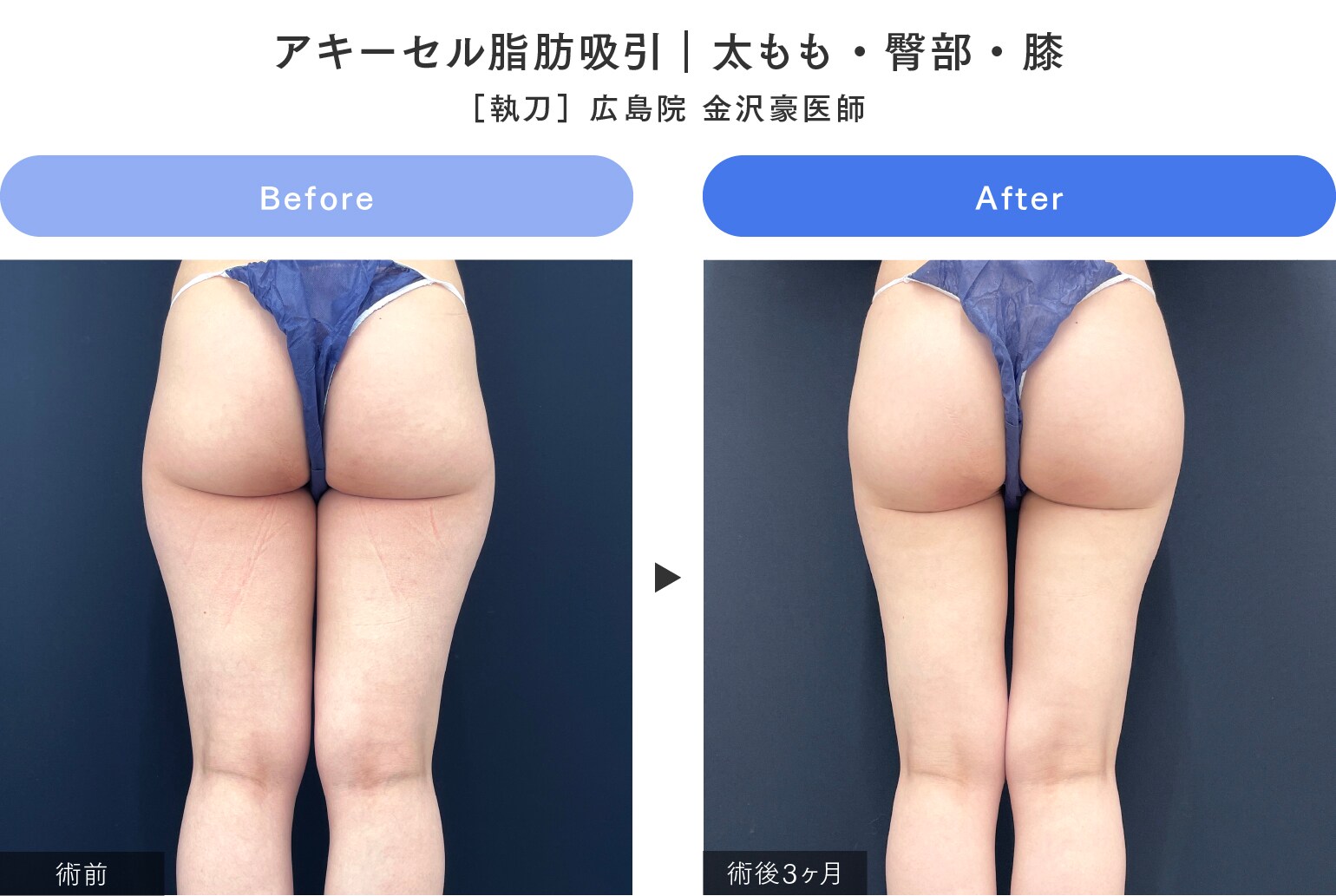 2017顔出しシミ付きパンツ 