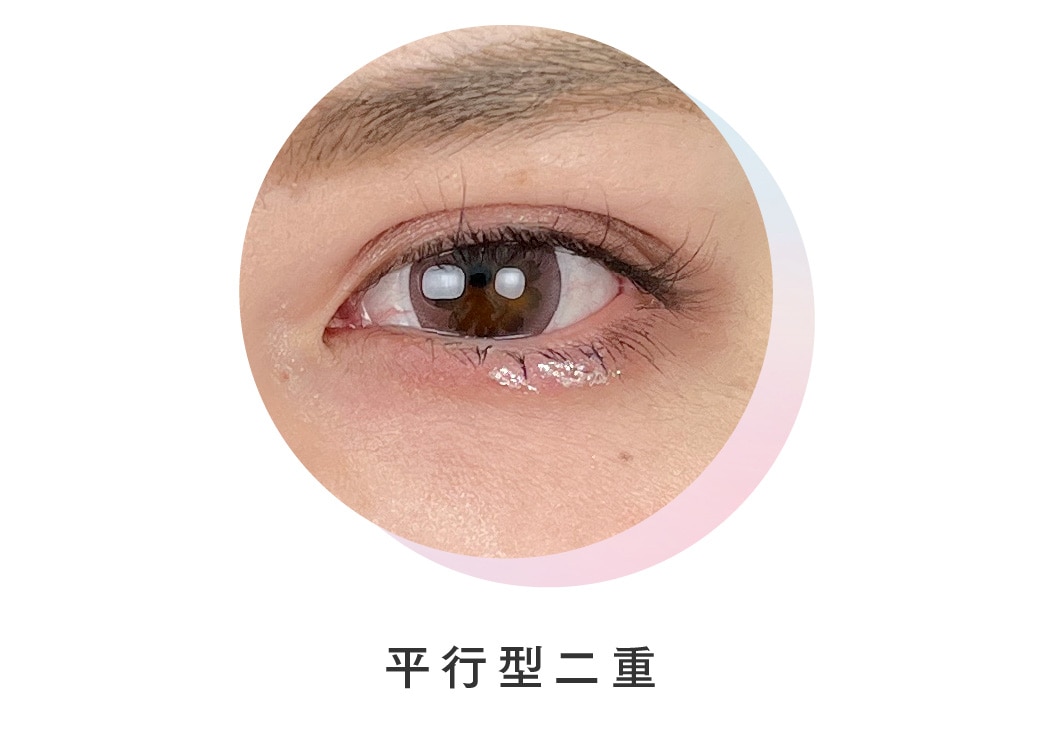 平行型二重