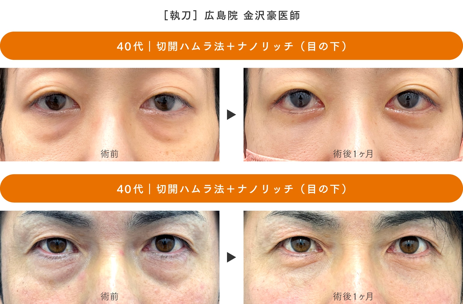 ［切開ハムラ法］40代のお客様