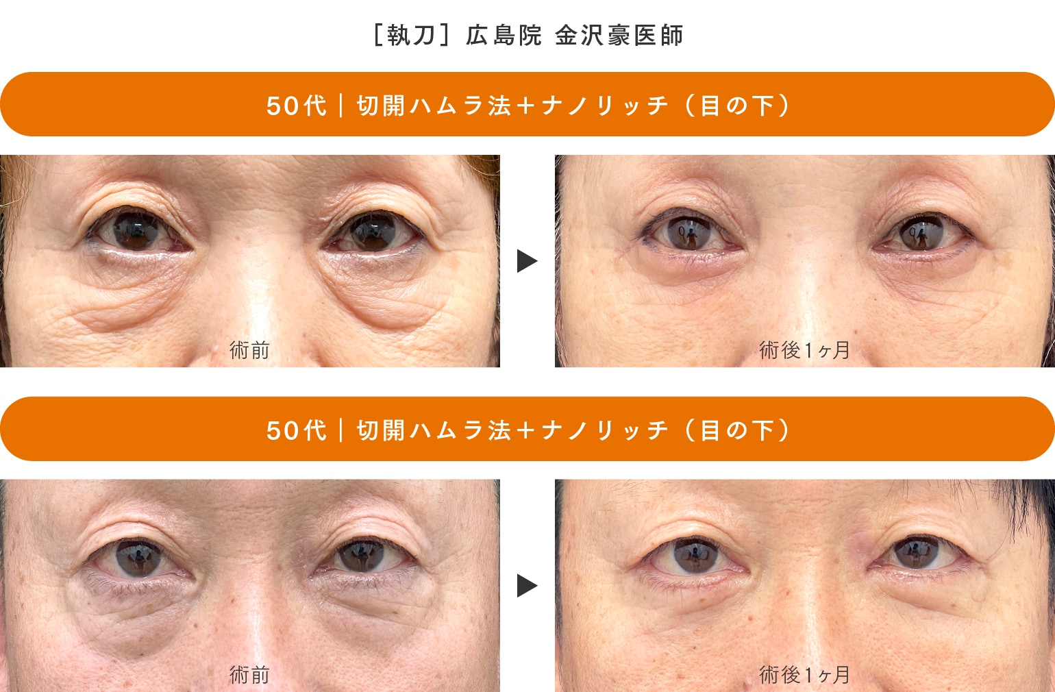 ［切開ハムラ法］50代のお客様