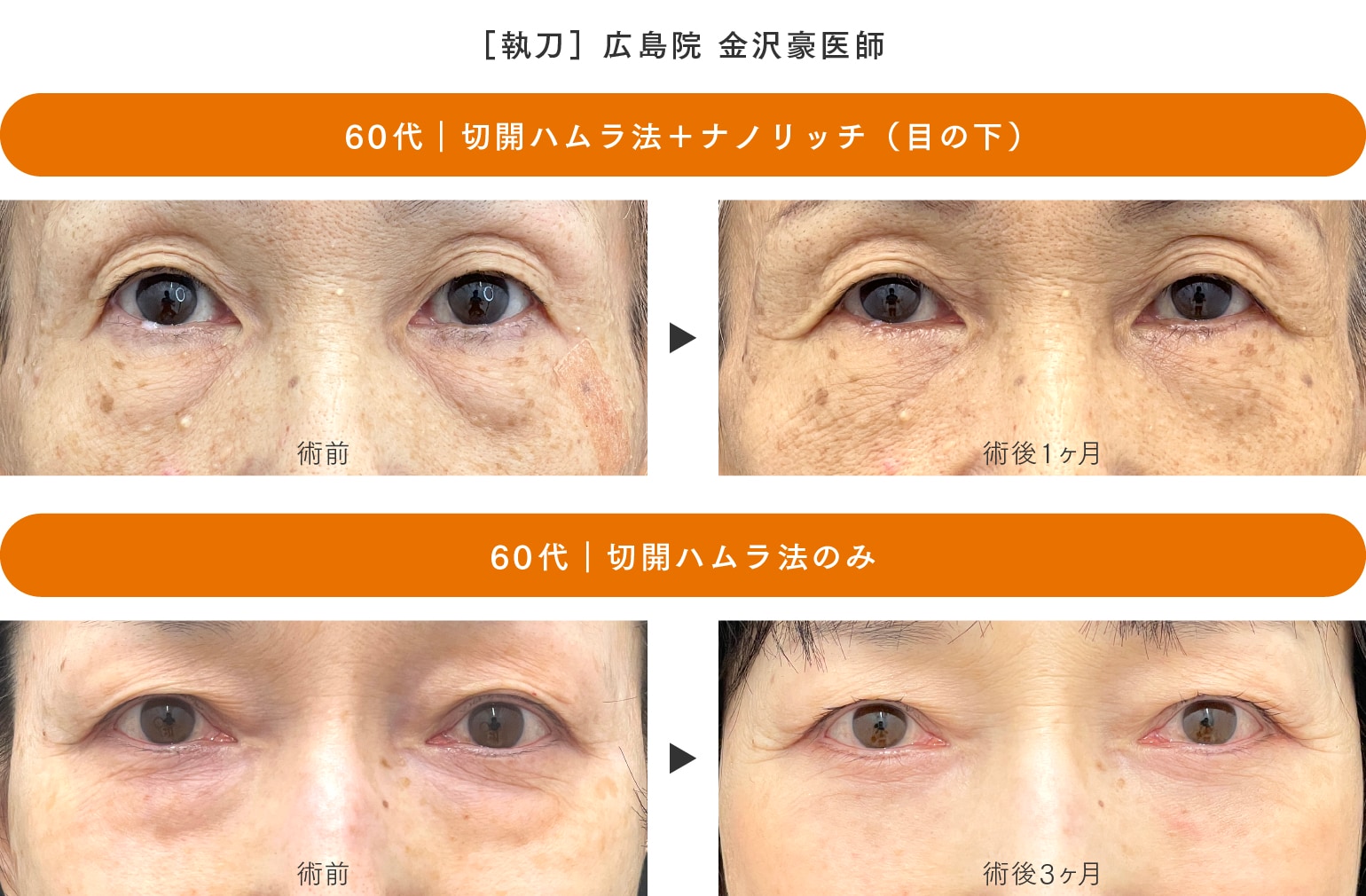 ［切開ハムラ法］60代のお客様