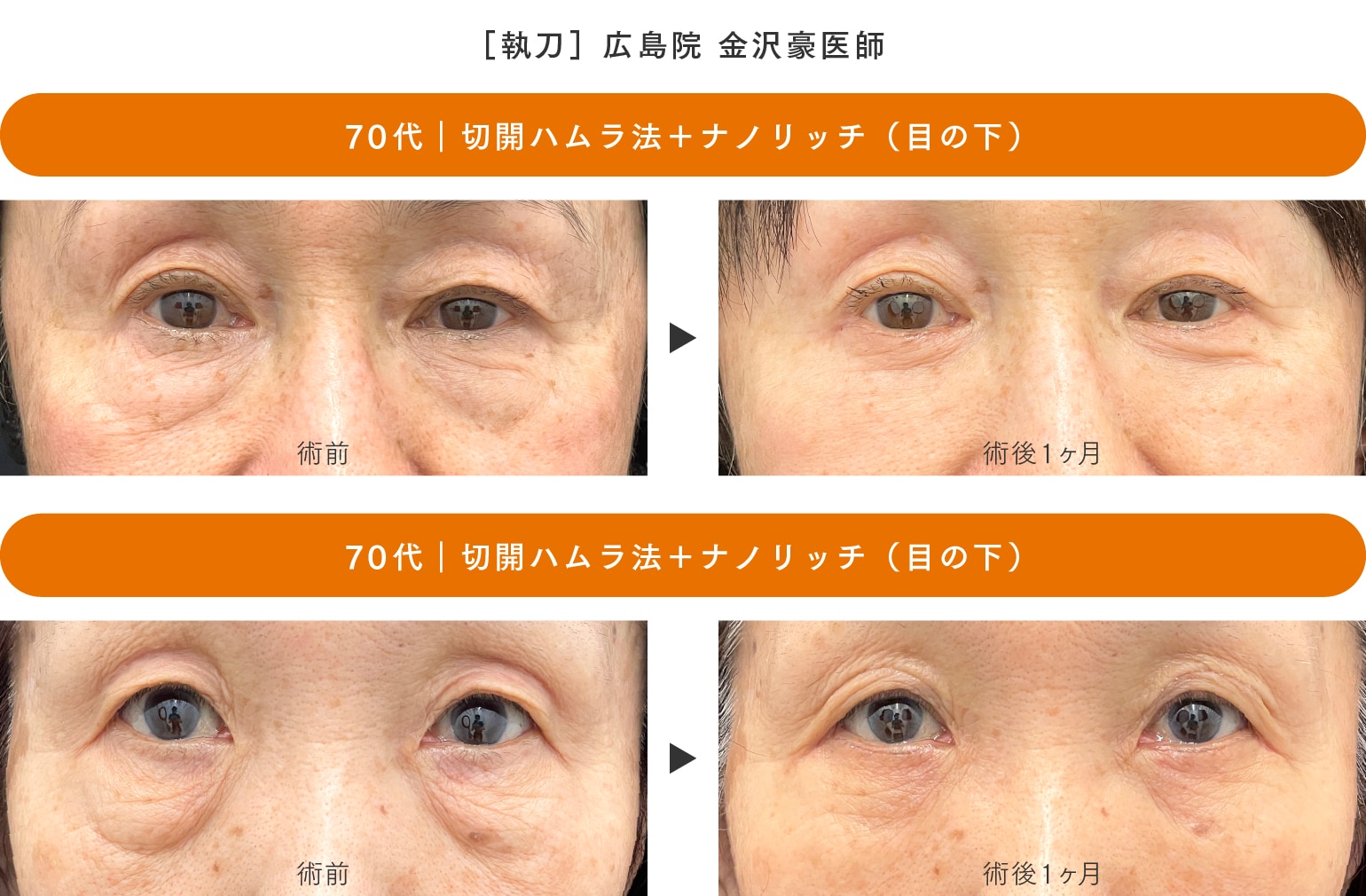 ［切開ハムラ法］70代のお客様