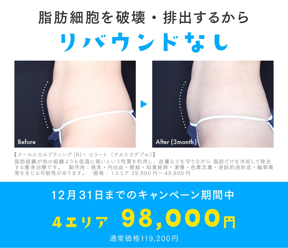 クールスカルプティング®エリート 4エリア