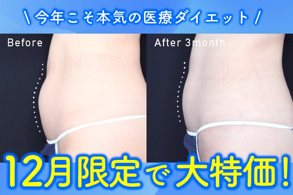 【広島 ダイエット】リバウンドしたくない方必見!厚生労働省認可の医療ダイエット機器で効果のある部分痩せ!