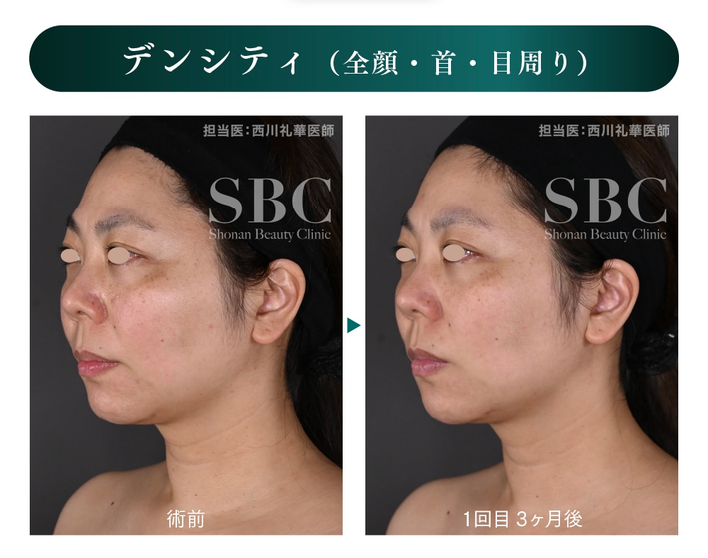 どちらも1回照射の症例写真です!