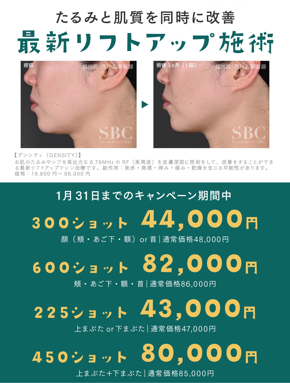 デンシティ各種1回