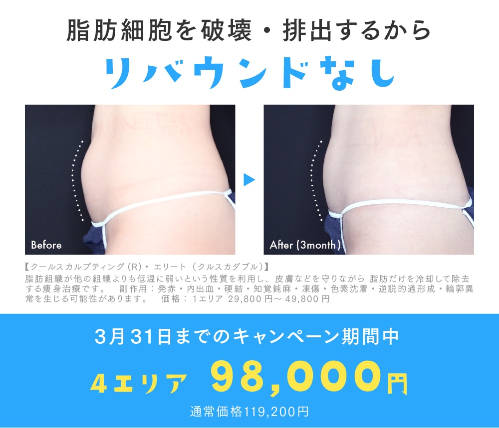 クールスカルプティング®エリート 4エリア