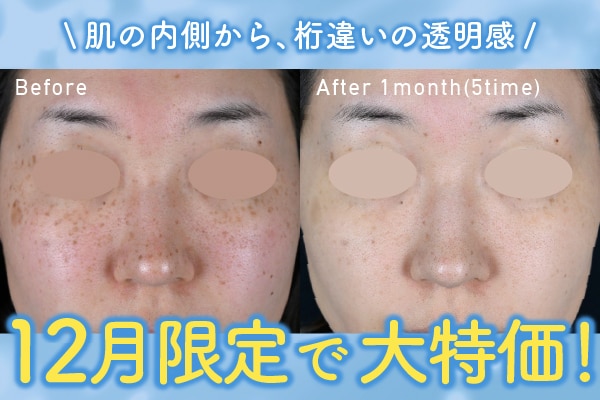 【広島 シミ改善】美肌への第一歩!IPL光治療で始めるシミ・ハリの集中ケア