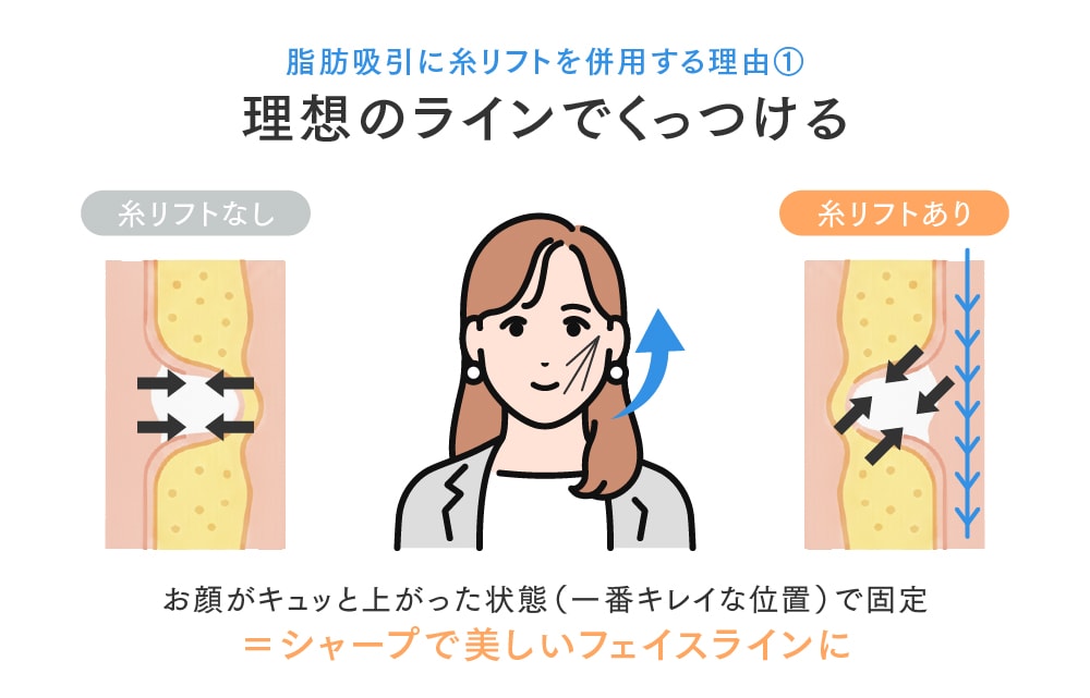 ①「理想のライン」でくっつける