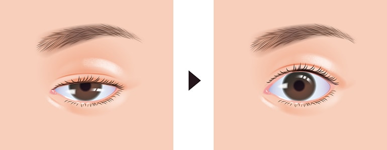 眼瞼下垂治療とは