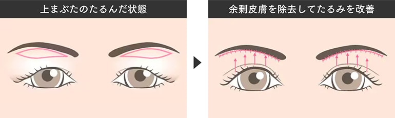 眉下リフト（眉下切開）とは