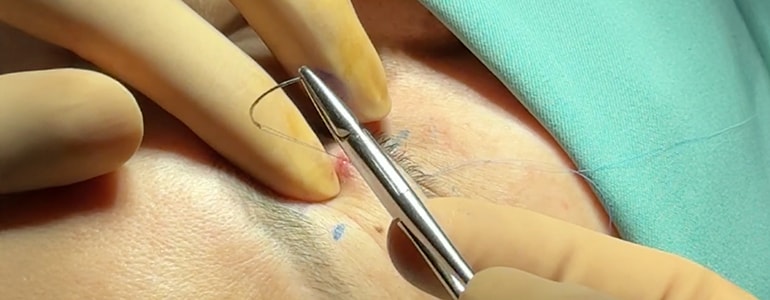 傷跡が目立たない丁寧な縫合