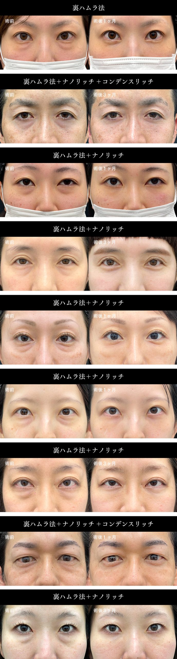 裏ハムラ法