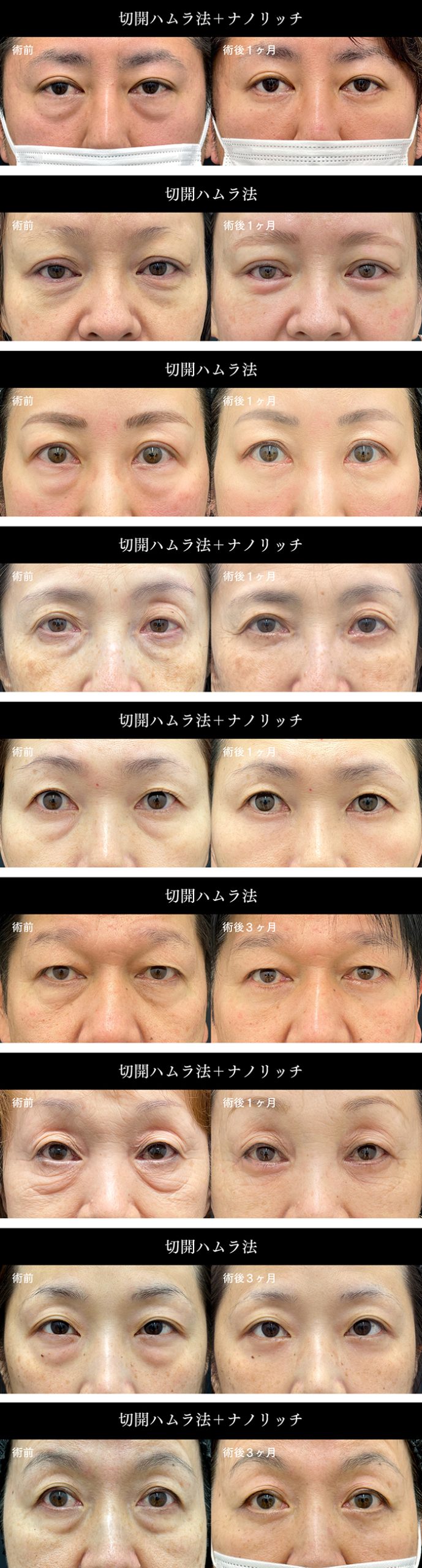 切開ハムラ法