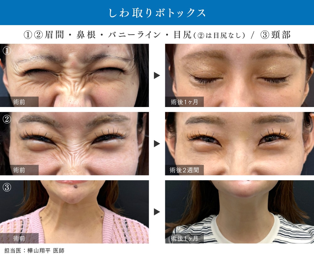  ②【表情ジワ予防＆改善】しわ取りボトックス