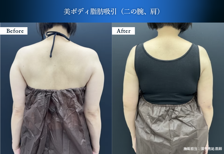 美ボディ脂肪吸引【二の腕・肩】
