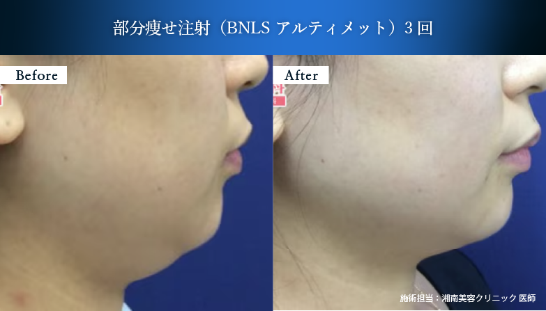 脂肪溶解注射