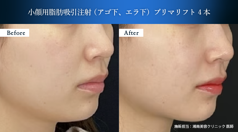脂肪吸引注射【頬・あご下】