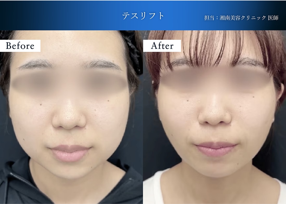 テスリフトには、大きく分けて3つの効果があります。