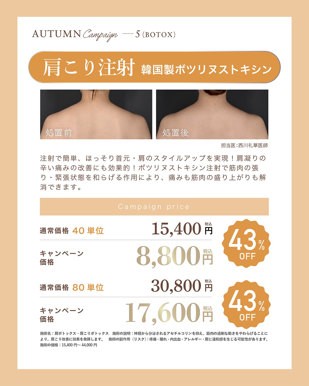 肩こりボトックス