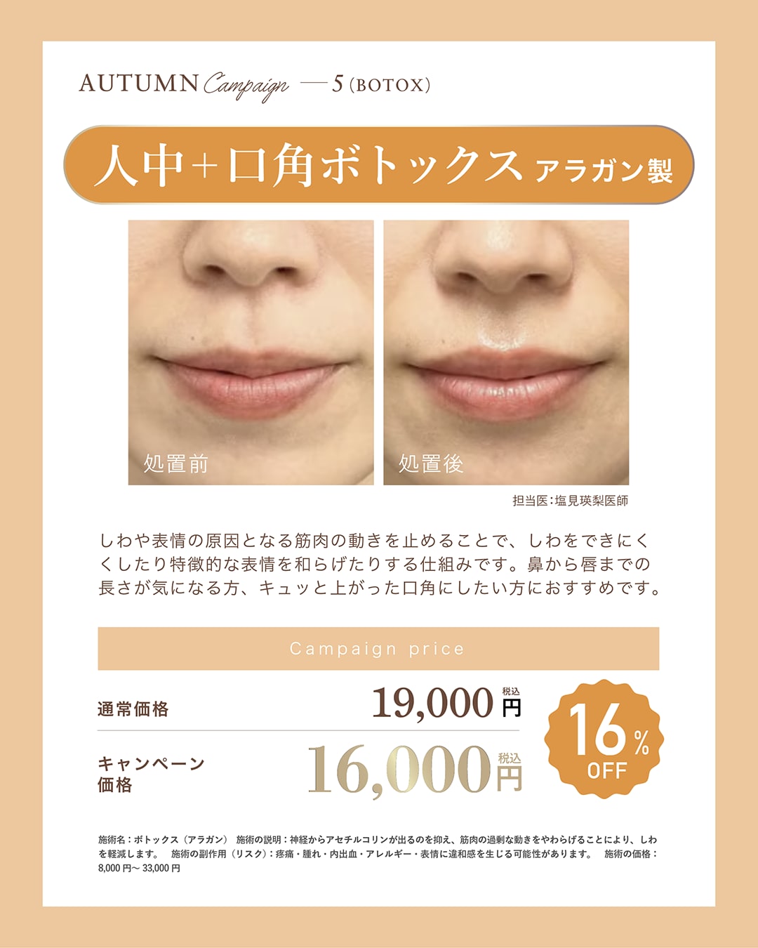 人中+口角ボトックス
