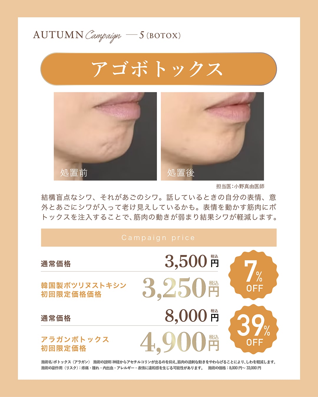 アゴボトックス