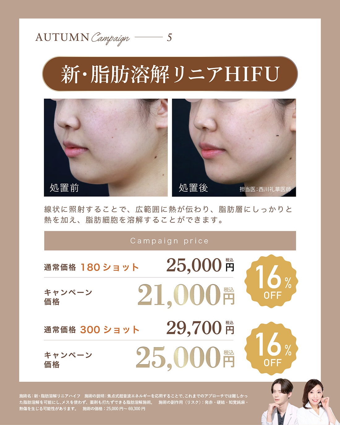 新・脂肪溶解リニアHIFU