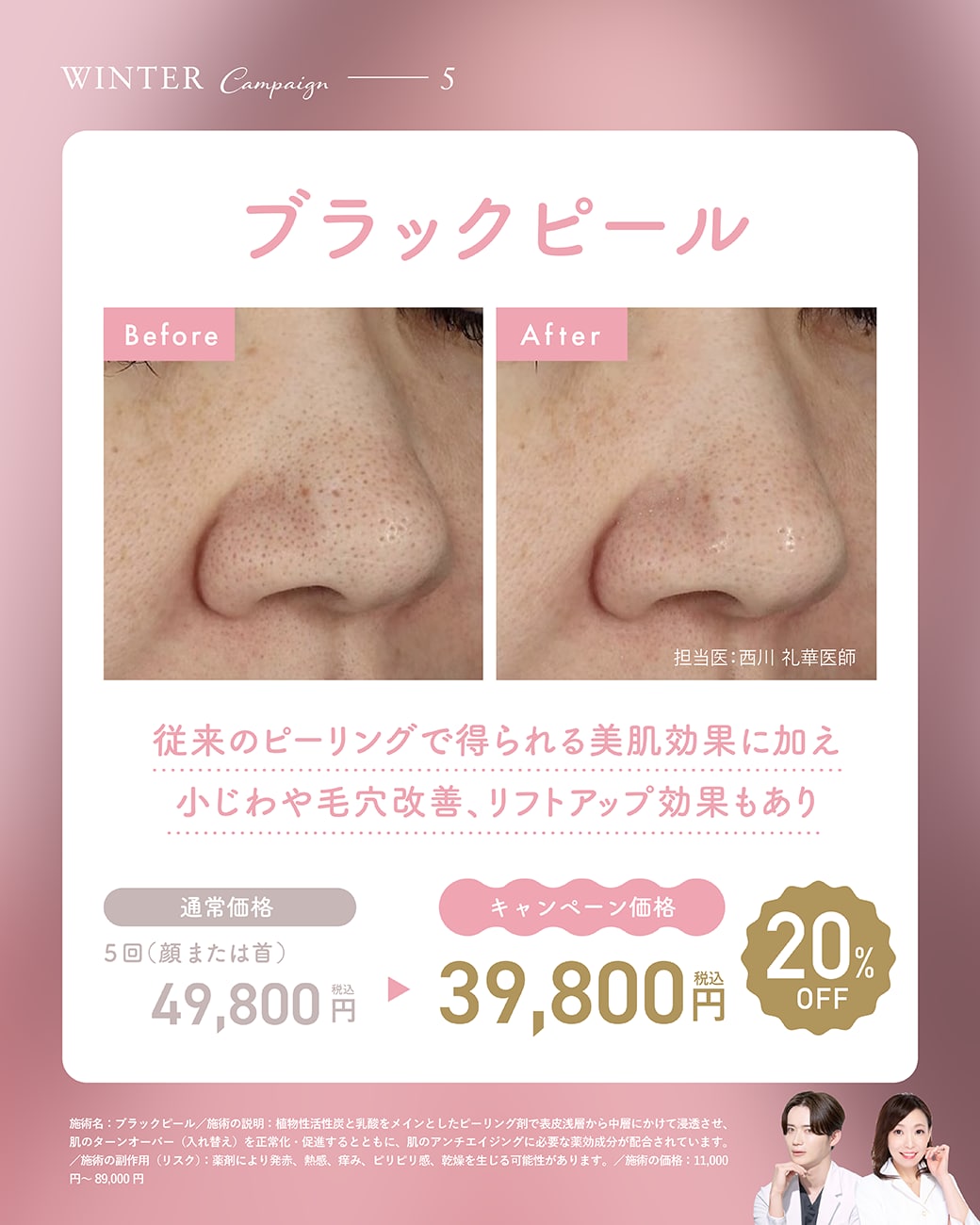 【取り扱い施術⑤】ブラックピール