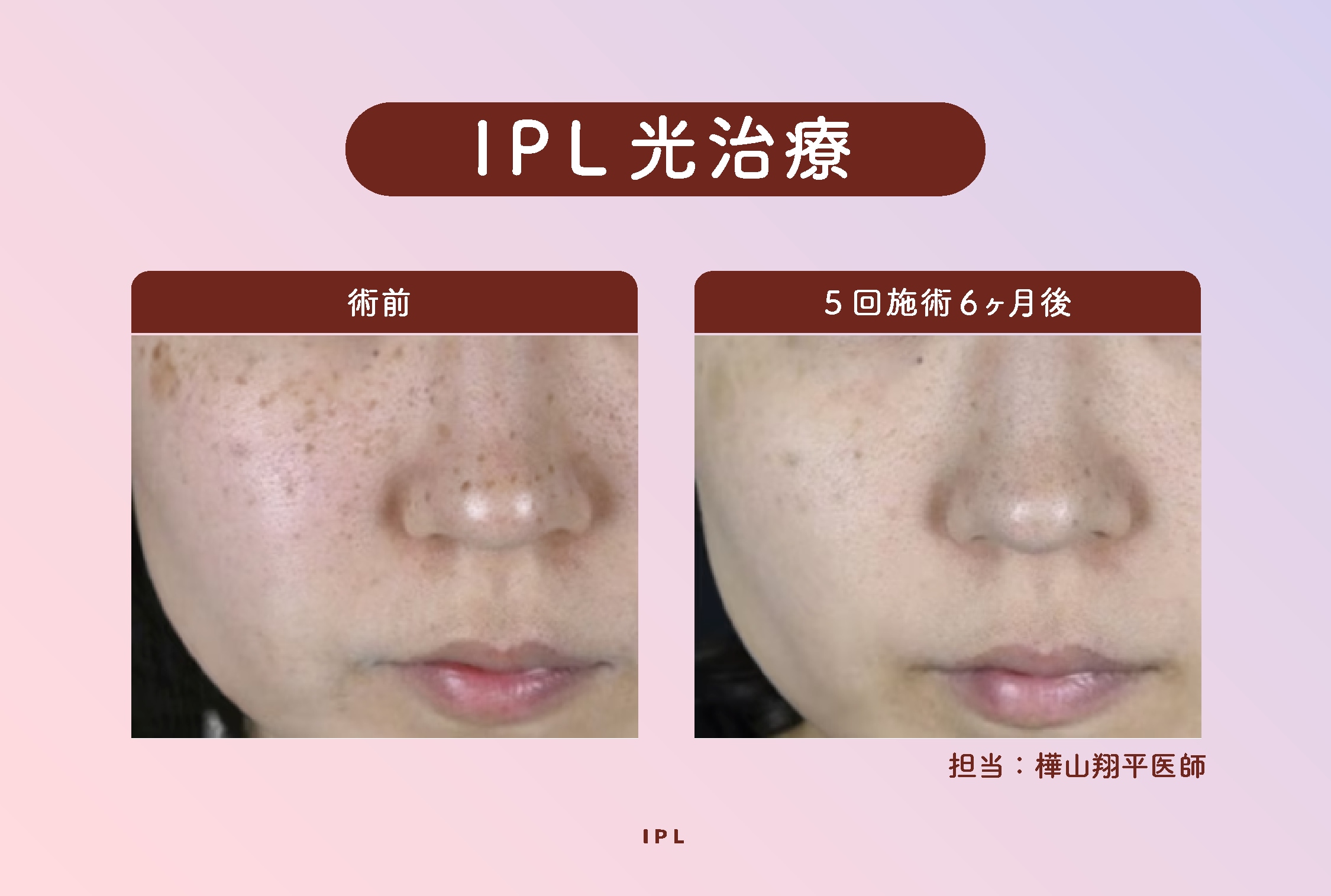 光でまとめて美肌ケア