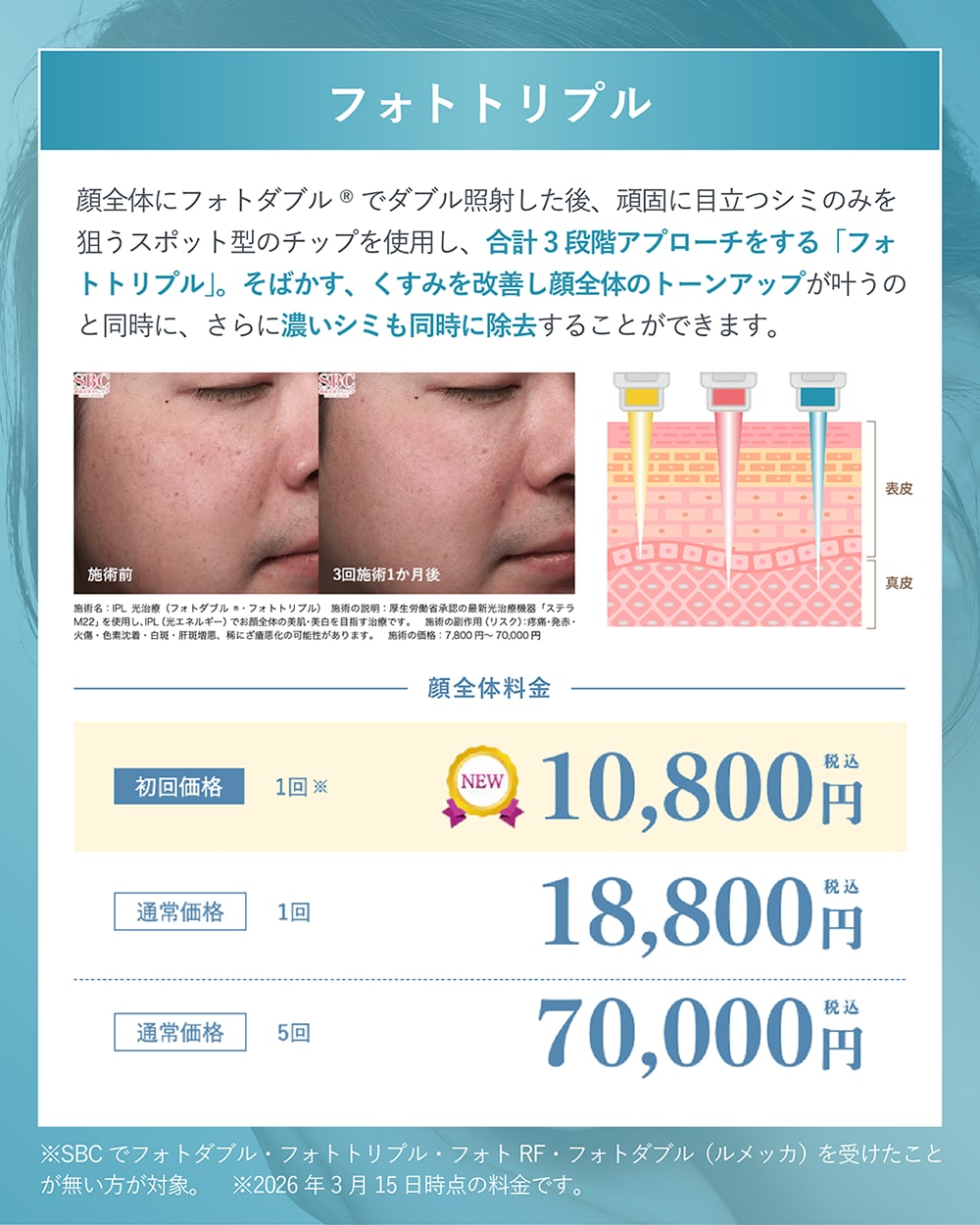 フォトトリプル l 濃いシミまでアプローチする光治療